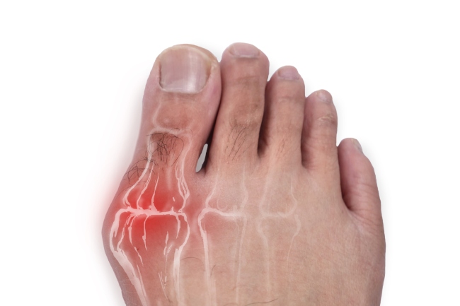 Bunion Treatment