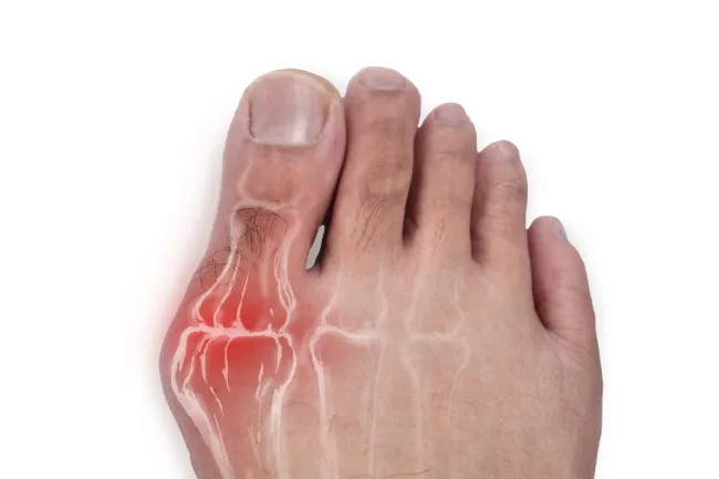 Bunion Treatment