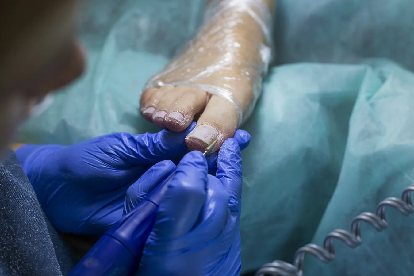 Ingrown Toenail Treatments
