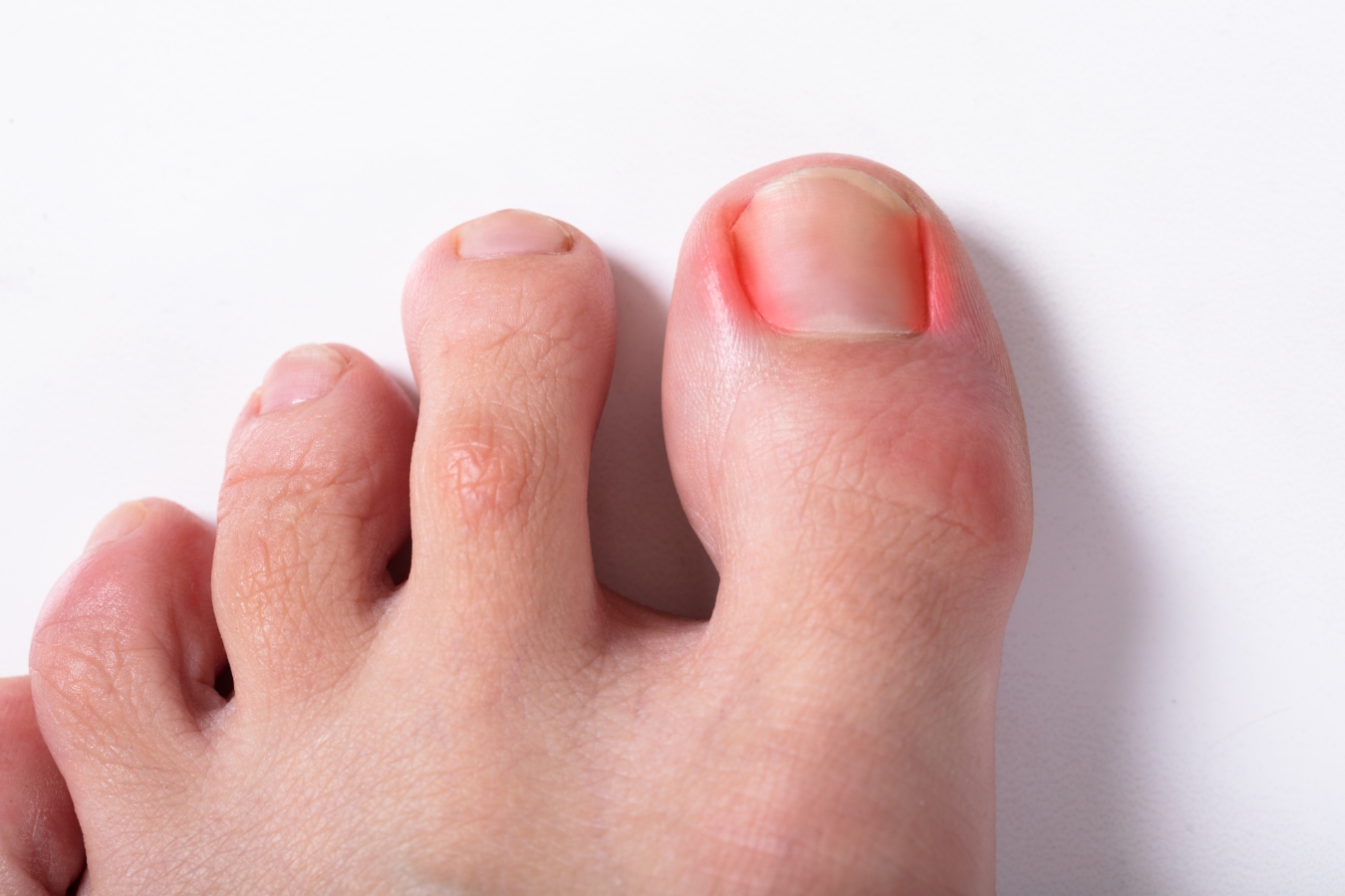 Ingrown Toe Nails Treatment