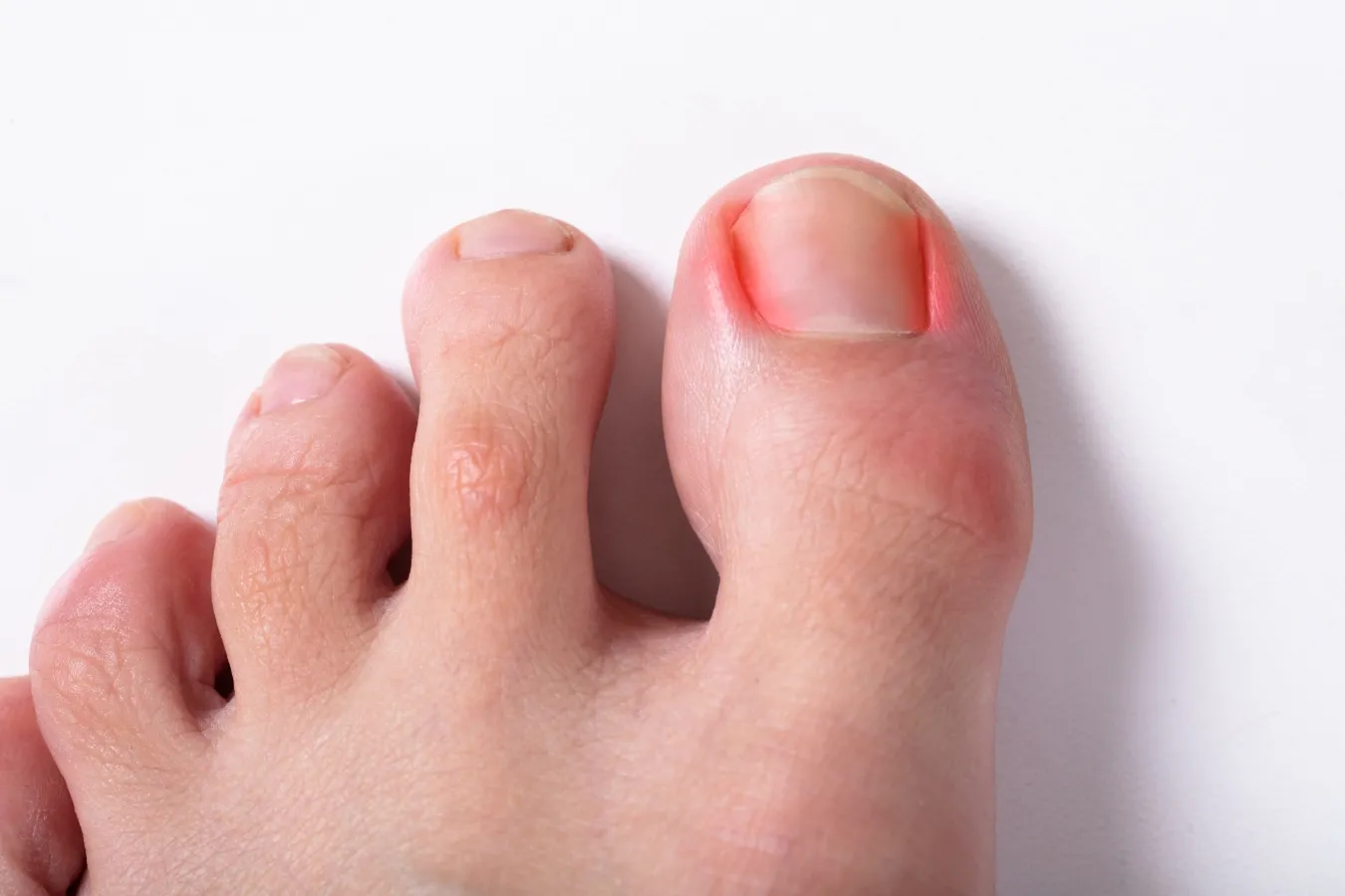 Ingrown Toe Nails Treatment