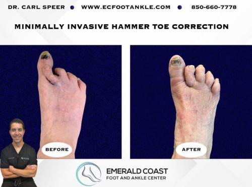 HammerToeBeforeAndAfter