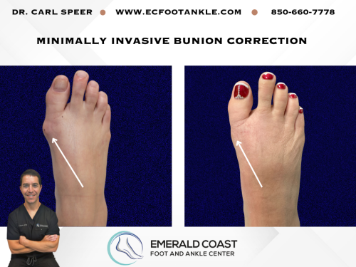MIS-Bunion-Correction-1