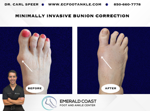 MIS-Bunion-Correction-2