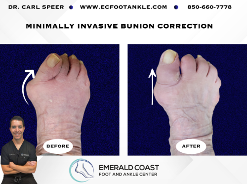 MIS-Bunion-Correction-3