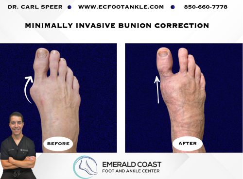 MIS-Bunion-Correction-4