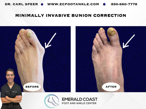 MIS-Bunion-Correction-5