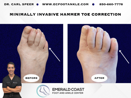 MIS-Hammertoe-Correction-1